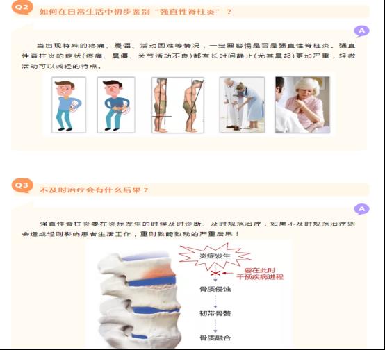 強(qiáng)直性脊柱炎